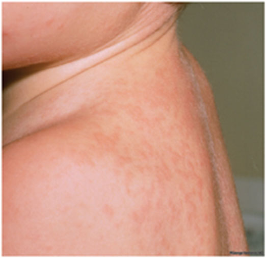 Infants and children with roseola have two main symptoms: a fever and rash. Often the fever seen is between 102 degrees Fahrenheit and 105 degrees Fahrenheit (38.9 and 40.5 degrees Celsius) and lasts for 3 to 5 days.