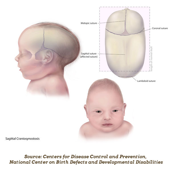 Uneven Head Shape In Babies Causes And Treatment Of Craniosynostosis Healthychildren Org