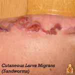 Sandworms - Image - HealthyChildren.org