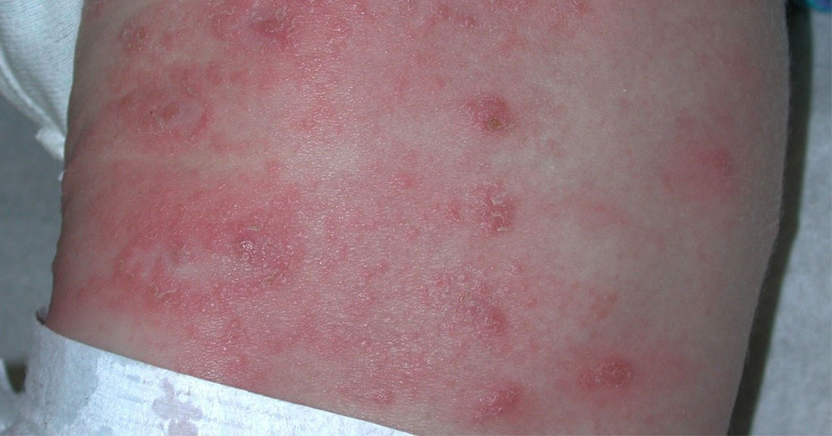 Scabies A Very Itchy But Curable Rash pic