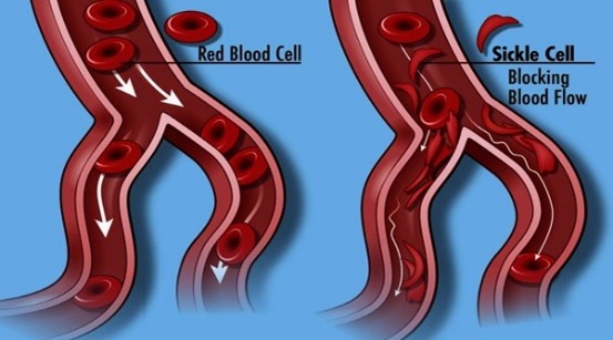 Sickle Cell Disease: Information for Parents 