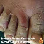Sweaty Sock Syndrome - Image - HealthyChildren.org