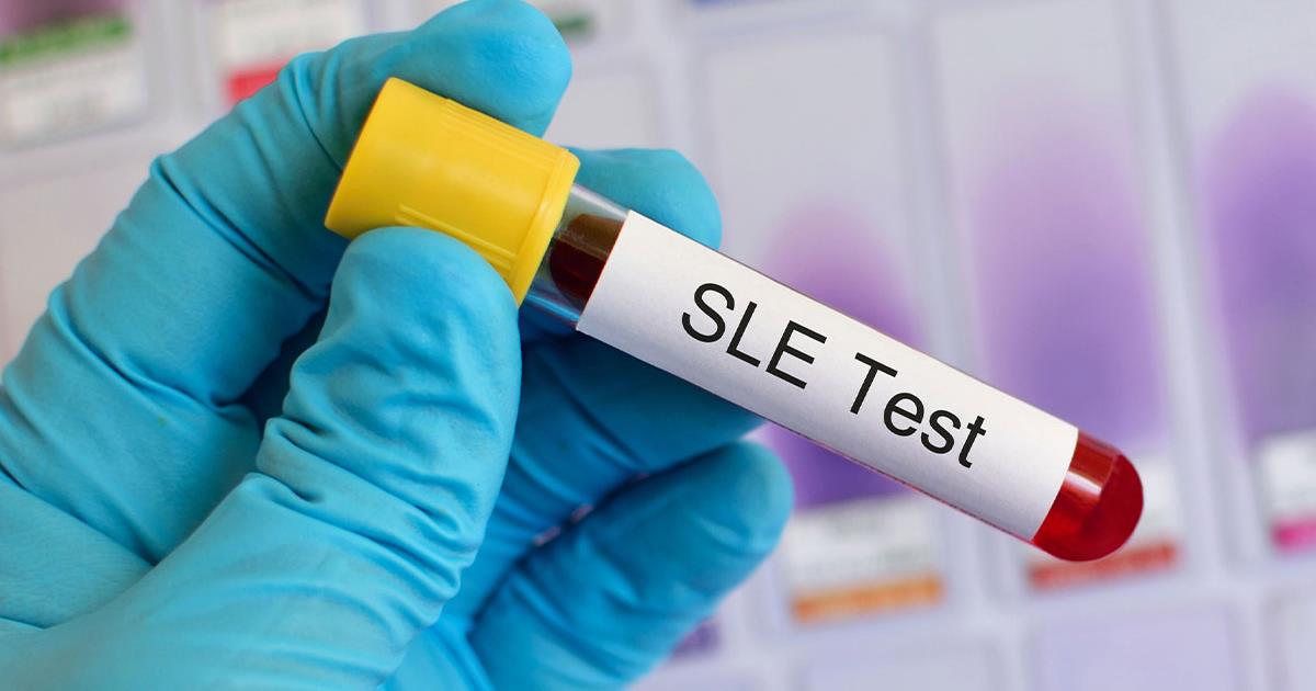 Lupus in Children & Teens: Parent FAQs - HealthyChildren.org