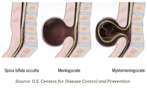 Spina Bifida: Types, Causes & Treatment for Children ...