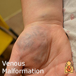 Venous Malformation - HealthyChildren.org