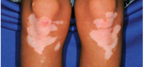 Skin with light patches on the knees, possibly indicating a condition like vitiligo. Background is blue.