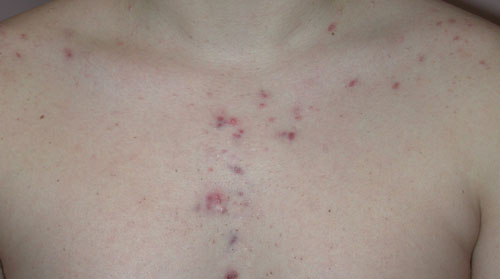 Acne in between breast – Back/Body/Neck acne –  Forum