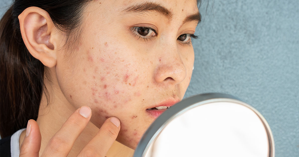homemade acne treatments for teens