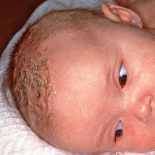 Qué es la costra láctea?¿Cómo quitar la costra láctea sin dañar el cuero  cabelludo del bebé? - Blog de Cestaland