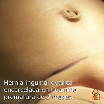 Hernia inguinal