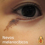 Nevos melanocíticos