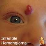 Infantile Hemangiomas - HealthyChildren.org