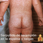 Imagen del sarpullido de sarampión en la espalda y nalgas.